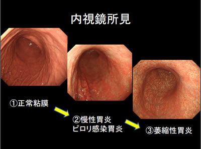 内視鏡所見　慢性胃炎