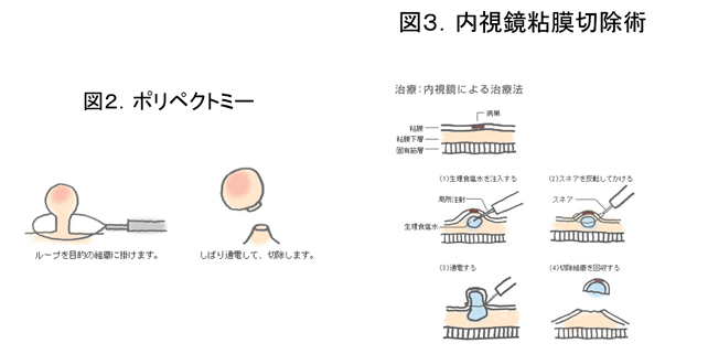 内視鏡的切除術