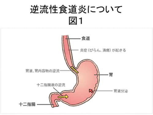 逆流性食道炎について