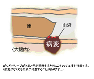 便潜血陽性とは