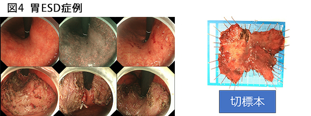 図4 胃ESD症例