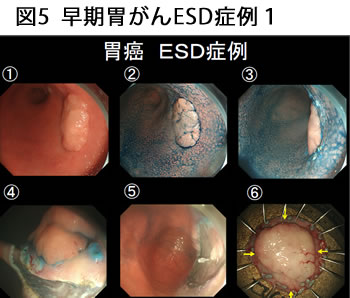 図5 早期胃がんESD症例1