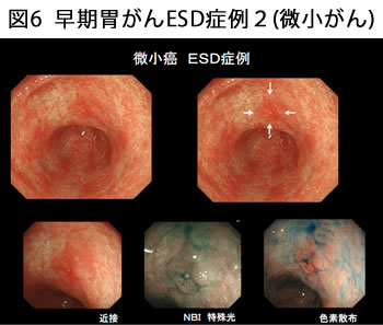 図6 早期胃がんESD症例2（微小がん）