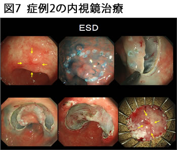 図7 症例2の内視鏡治療