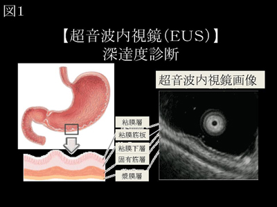 図1．【超音波内視鏡(EUS)】深達度診断