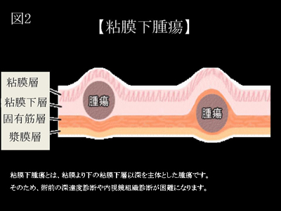 図2．粘膜下腫瘍