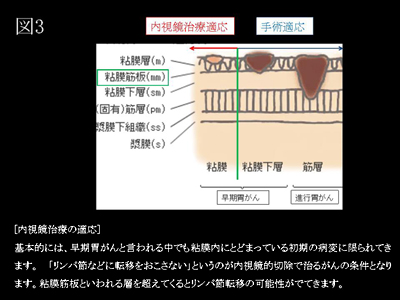 図3．内視鏡治療の適応