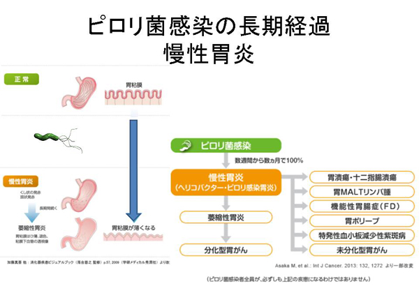 ピロリ 菌 症状