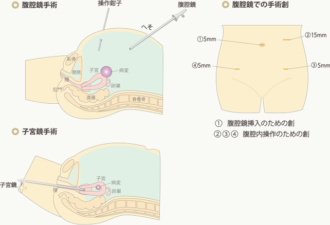 婦人科手術