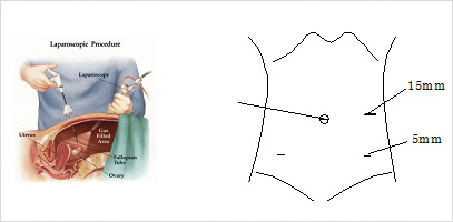 腹腔鏡手術とは