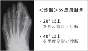 外反母趾の診断