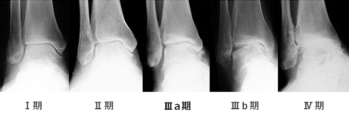 病期分類写真