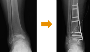 骨切り(脛骨遠位斜め骨切り/DTOO)写真
