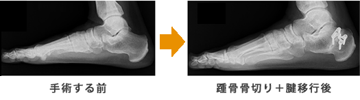 手術前から踵骨骨切り＋腱移行後の写真