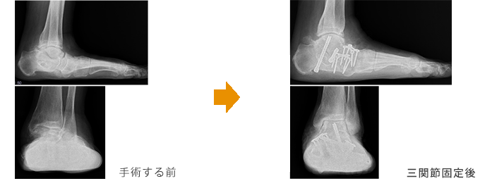 手術前から三関節固定後の写真