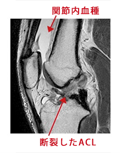 関節内血種と断裂したACL