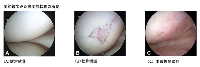 関節鏡で見た膝関節軟骨の所見