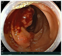 そけいヘルニアの腹腔鏡写真