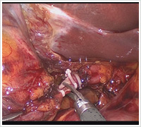 そけいヘルニアの腹腔鏡写真