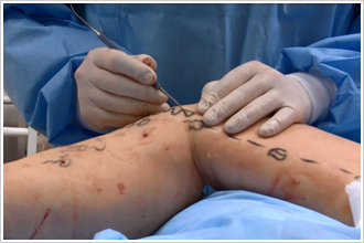 スタブ・アバルジョン法−最小の傷による手術