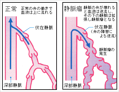 下肢静脈瘤の原因は？